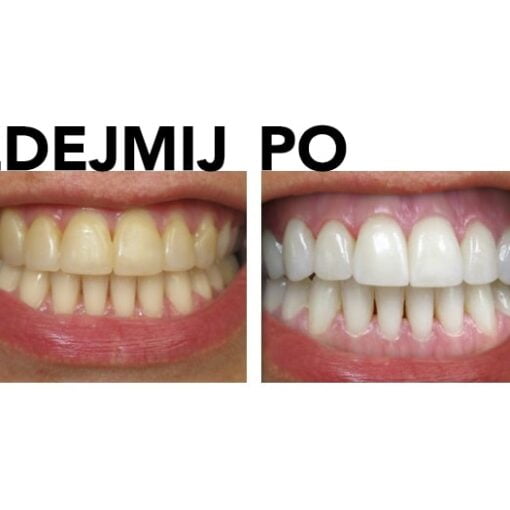 Zestaw do wybielania zębów przed i po zdjęciu przeglądu