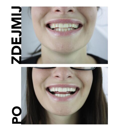 naturalna pasta do wybielania zębów przed i po zabiegu